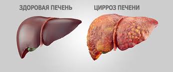 Cirroz Pecheni Lechenie I Simptomy Priznaki Cirroza U Muzhchin I Zhenshin Gepatit Ru