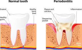 Gum Disease Periodontal Treatment In Brandon Fl Dr Fadi