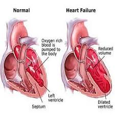 Hemodynamic alterations and remodeling … cardiac or ventricular remodeling) in response to hemodynamic load and/or cardiac injury, in association with neurohormonal activation and other factors. Causes And Diagnosis Of Congestive Heart Failure Heart Failure Congestive Heart Failure Cardiac Nursing