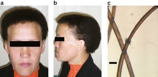 Autosomal Recessive Hypotrichosis with Woolly Hair Caused by a Mutation in  the Keratin 25 Gene Expressed in Hair Follicles