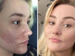 I think the best vitamin c skin care products are serums because they are more effective at penetrating the skin barrier than, say, a cream or for the winter months, when skin tends to be drier, consider switching to a vitamin c oil. Reddit User I Cured My Horrible Acne In One Week By Doing One Thing 7news