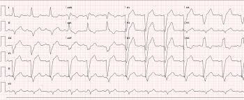 It's description is therefore quite lengthy. Figure 1 Severe Myocardial Ischemia In A Patient With Diabetes Mellitus And Left Bundle Branch Block Springerlink