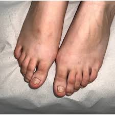 Image result for Onychogryphosis feet