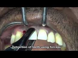 Full recovery from the surgery can take about a week, sometimes more, depending upon a patients age and if they undergo a full or. Full Mouth Extraction Of Teeth Due To Severe Agressive Periodontitis Youtube