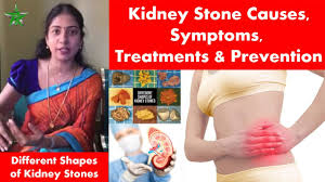 Kidney Stone Causes Symptoms Treatments Prevention In Tamil Asha Lenin Youtube