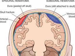 Hematomul epidural sau hematomul extradural este un tip de hematom care apare când artera se împarte între suprafața exterioară a dura mater și craniu. Tratamentul Hematomului Subcutanat Cauze Èi Cele Mai Eficiente Tratamente Pentru Hematomul Subcutanat Pe Picior