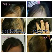However, hair loss is common in both genders, which causes the hair to become thin and look unattractive. Http Creciones Artesana Blogspot Com Cedarwood Yl Oil Knee Pain Oils Recipes Living Oils Essential Oils