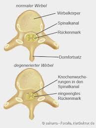 Spinalkanalstenose Ursachen Symptome Therapie Netdoktor
