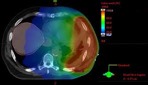 How does mesothelioma cause pain in the back? Pain Management In Patients With Malignant Mesothelioma Challenges An Lctt