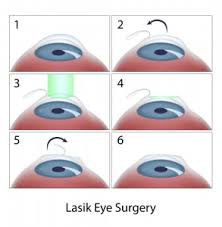 The most common procedure is a capsulotomy after cataract surgery. How Does Laser Eye Surgery Work Eye Care Specialists