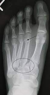 Ebraheim's animated educational video describing lisfranc injury. Lisfranc Injury Wikipedia