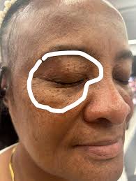 How to treat Seborrheic keratosis holistically?