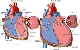 Myocarditis is an inflammation of the heart muscle (myocardium). Myocarditis Diagnosis Symptoms And Treatment