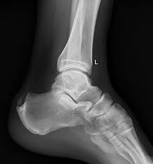 Haglund syndrome refers to the triad (haglund triad) of: Preoperative Lateral Radiograph Showing Haglund S Deformity Fig 3 Download Scientific Diagram