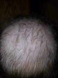 They are also great for. Using A Stiff Boar Hair Brush To Regrow Hair After 40 Years Balding