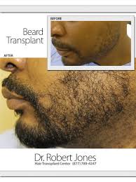 visit us www drrobertjones beard transplant hair transplant beard