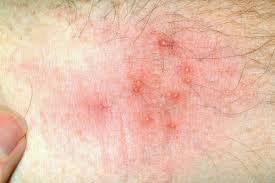 Image result for scabies human bites