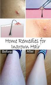 Though ingrown hairs are not dangerous they can be painful and unappealing. Pin On Health Issues