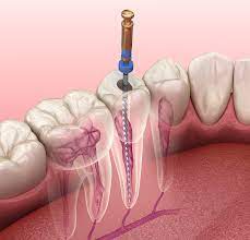New York City Root Canal Upper East Side Endodontics