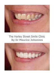 We did not find results for: Veneers For Crooked Teeth Harley Street Smile Clinic