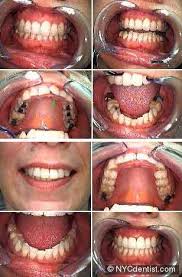 To replace them, to put on a crown), then yes. Dr Jeffrey Dorfman Dentist