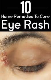 12 Home Remedies To Get Rid Of A Rash Around The Eyes Home Remedies Eyelid Dermatitis Rashes Remedies