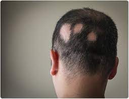 William gaunitz discusses hair loss treatment results and hair transplants with arizona news nbc female hair loss treatment in arizona. What Is Alopecia