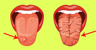 7 Changes In Your Tongue That Are Warning Signs Canker Sore On Tongue Burning Tongue Syndrome White Sore On Tongue