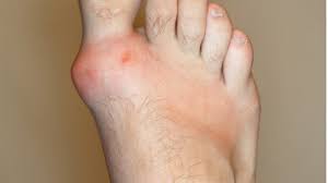 Image result for gout symptoms toe