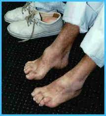Maybe you would like to learn more about one of these? Enfermedad De Charcot Marie Tooth Trastorno Neurologico Progresivo Guia De La Discapacidad