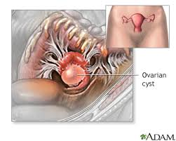 In this educational video, dr. Pelvic Laparoscopy Information Mount Sinai New York