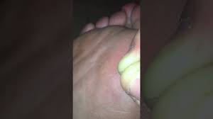 Dog Hair Splinter In My Foot Youtube