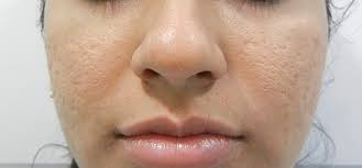 Laser Skin Lightening Treatment Skin Whitening Treatment Clinics