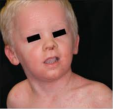 Is This Psoriasis—or Something Else?