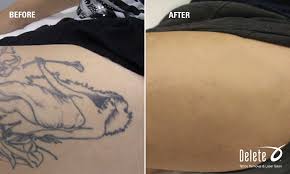 Picosure laser tattoo removal at phoenix skin spa (up to 70% off). Pin By Aleksandr Esaiashvili On Udalenie Tatu Laser Tattoo Removal Tattoos Tattoo Removal