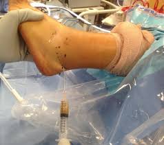Image result for Septic Joint