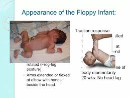 Image result for Floppy Infant