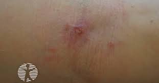 Image result for Pathergy