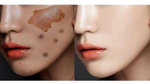 How To Get Rid Of Pigmentation Dark Spots Uneven Skintone In Just 7 Days Ice Cube Remedy Youtube Uneven Skin Tone Pigment Dark Spots