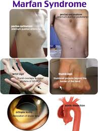 Marfan Syndrome Marfan Syndrome Medical Knowledge Medical Mnemonics