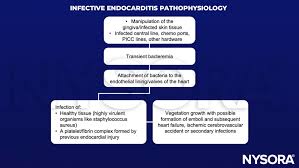Image result for SBE Prophylaxis