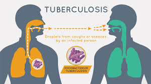 the right diet to beat tuberculosis tuberculosis center