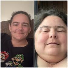 One year weight loss progress after bariatric surgery