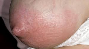 Find out what mastitis is, how to tell if you have mastitis, how to treat mastitis, and how to prevent and, unfortunately, a case of mastitis can really shake things up. Mastitis Babycentre Uk