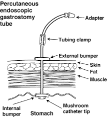Cleveland Clinic Percutaneous Endoscopic Gastrostomy Peg Peg Tube Nursing Notes Nursing School Tips