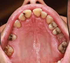 Image result for Candidiasis