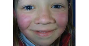 Image result for vyrážka u dětí