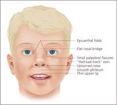 Fetal Alcohol Syndrome And Fetal Alcohol Spectrum Disorders American Family Physician