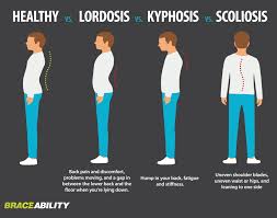 Do You Have A Curved Spine Scoliosis Exercises Scoliosis Curved Spine