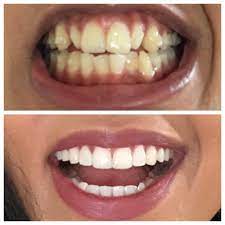 Check spelling or type a new query. Done 16 Months 1 Set Of Refinement Trays Crest White Strips And Some Cosmetic Bonding Invisalign